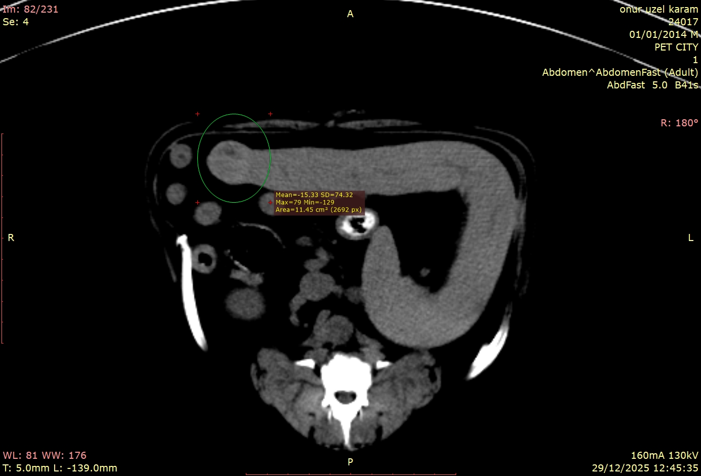 Erken Teşhis Hayat Kurtarır: Belirti Vermeyen Dalak Kitlelerini Nasıl Yakalıyoruz?